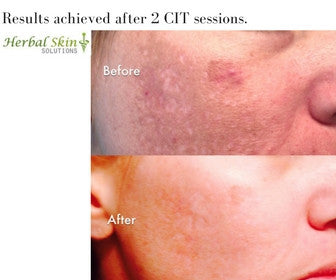 Hyper pigmentation correction by the CIT Pen, exclusively from Herbal Skin Solutions